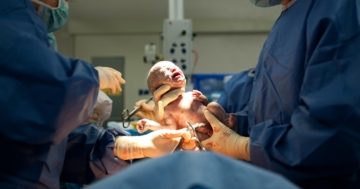 bambino che nasce con parto cesareo