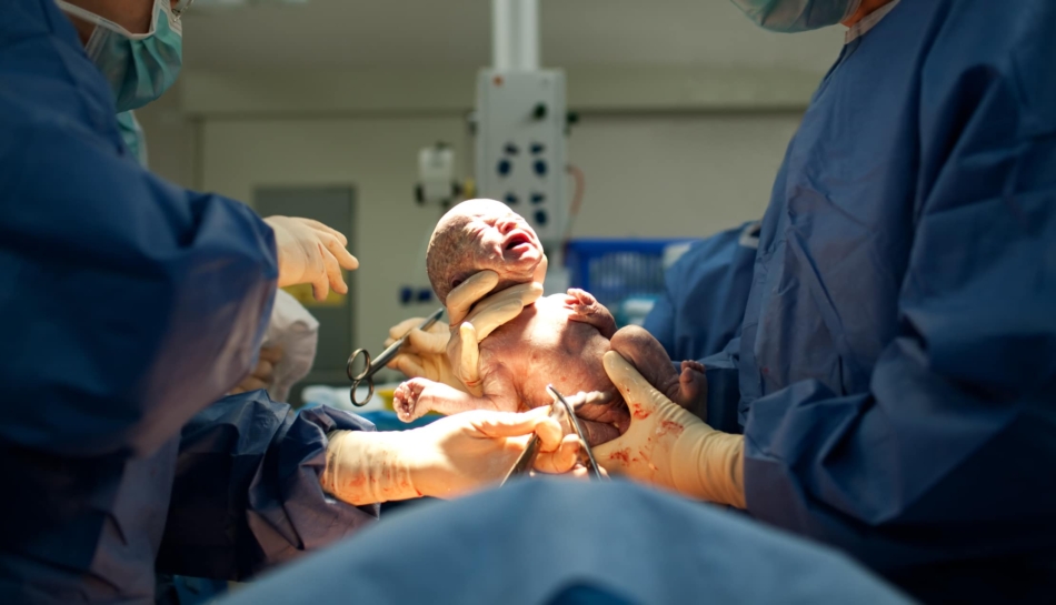 bambino che nasce con parto cesareo