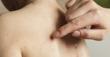 Vescicole tipiche dell'impetigine bollosa