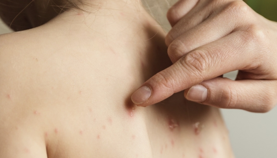 Vescicole tipiche dell'impetigine bollosa