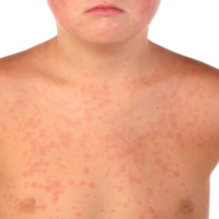 La Sesta Malattia Cos E E Come Si Cura Uppa It