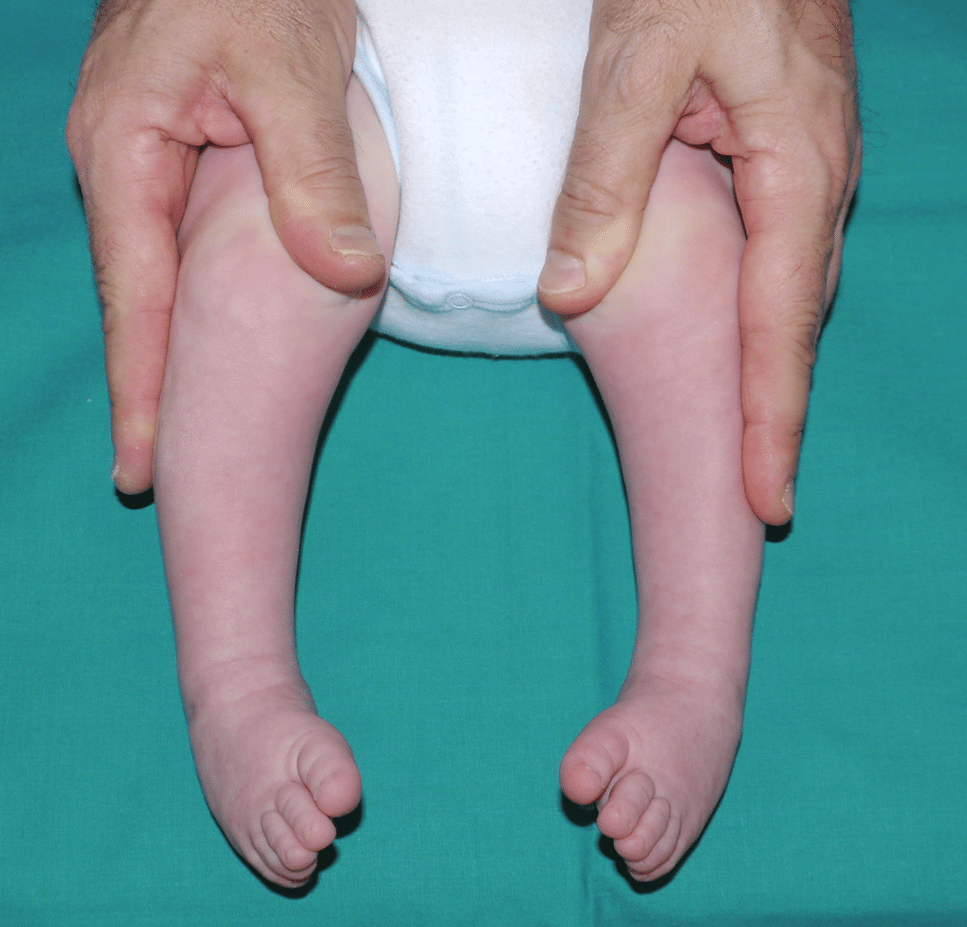 Bambino con piede torto congenito