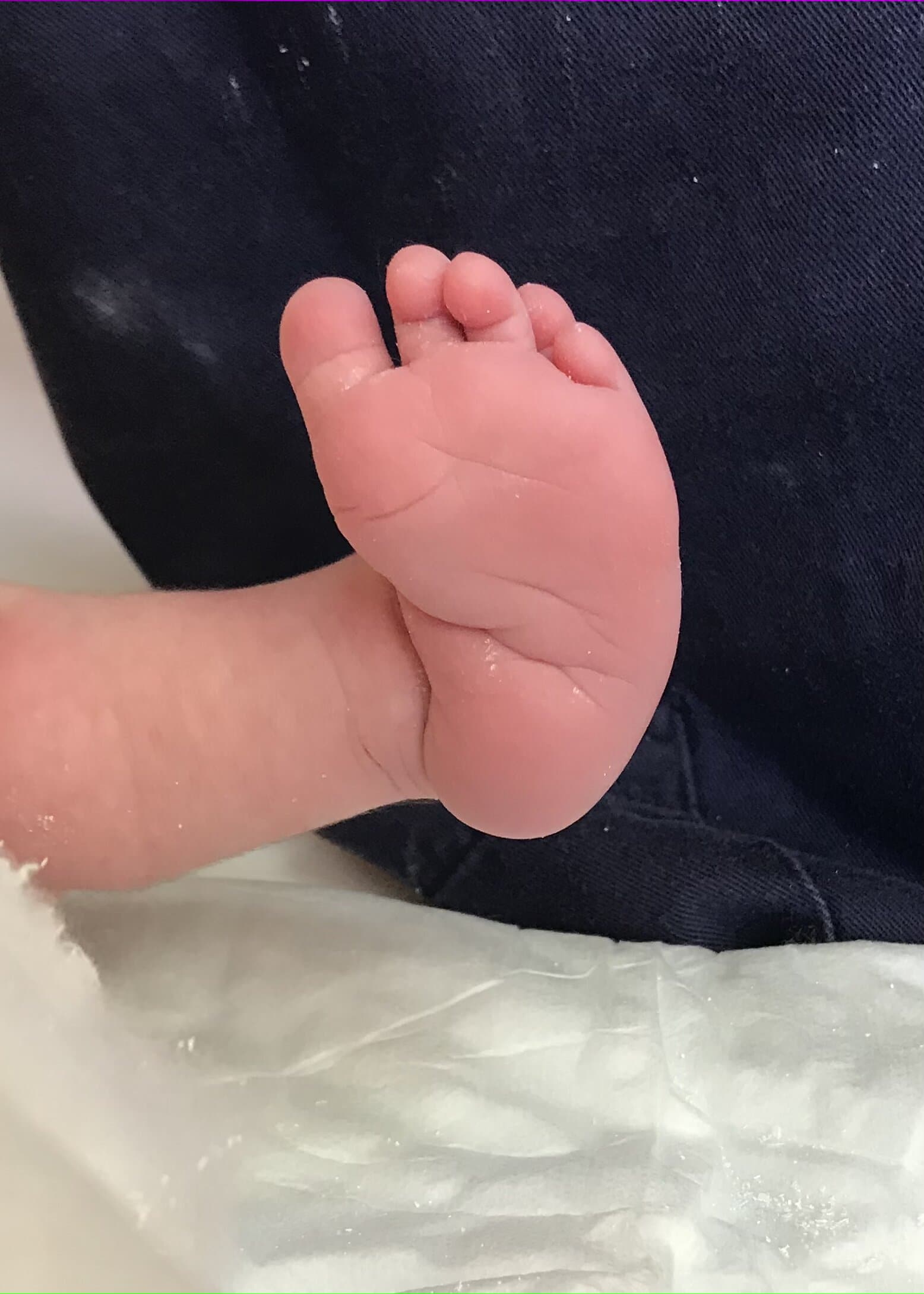 Dettaglio del piede torto congenito