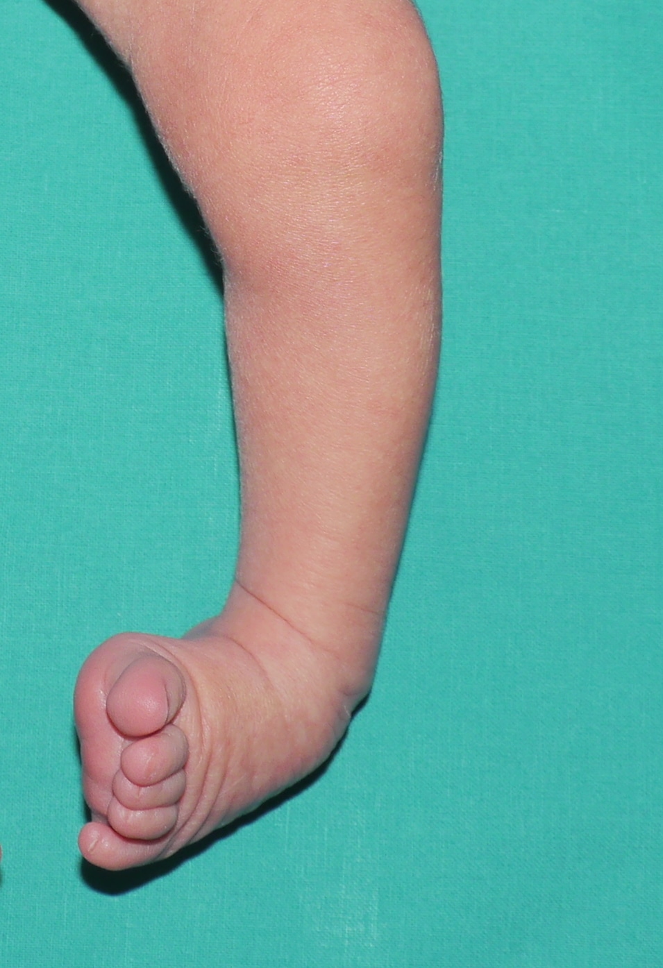 Dettaglio arto di un bambino con piede torto