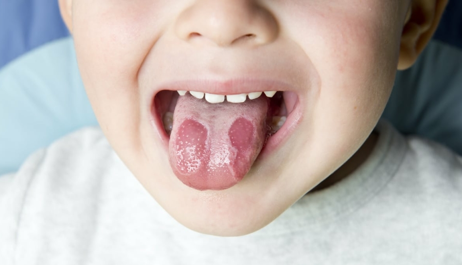 Stomatite nei bambini, un'infiammazione senza causa? - Uppa