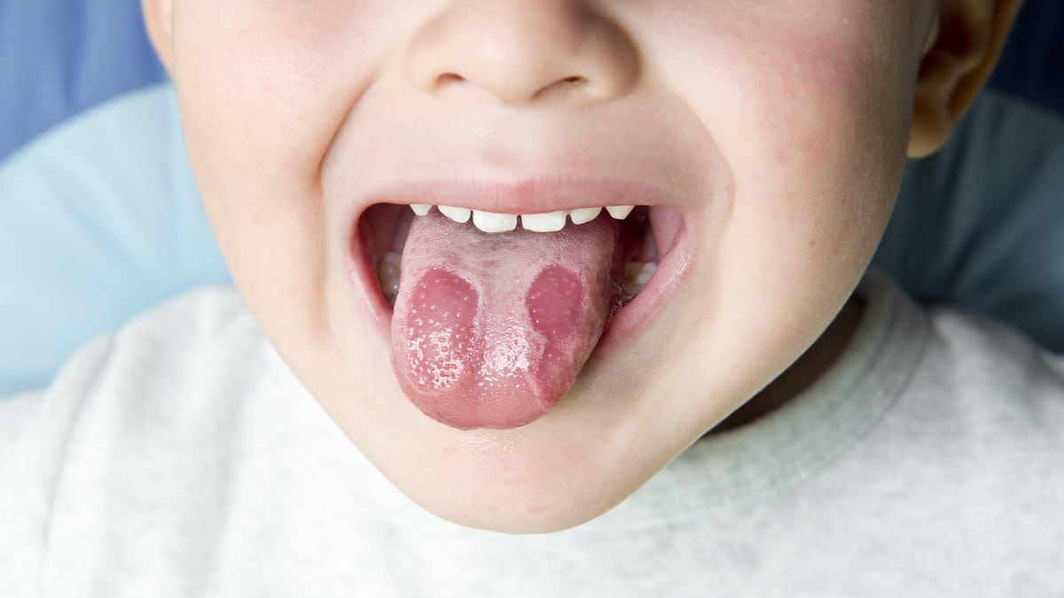 Bolle Di Sangue Sotto La Lingua Stomatite nei bambini, un’infiammazione senza causa? - Uppa