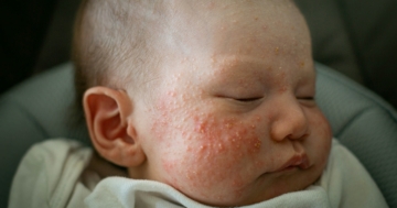 neonato affetto da acne neonatale