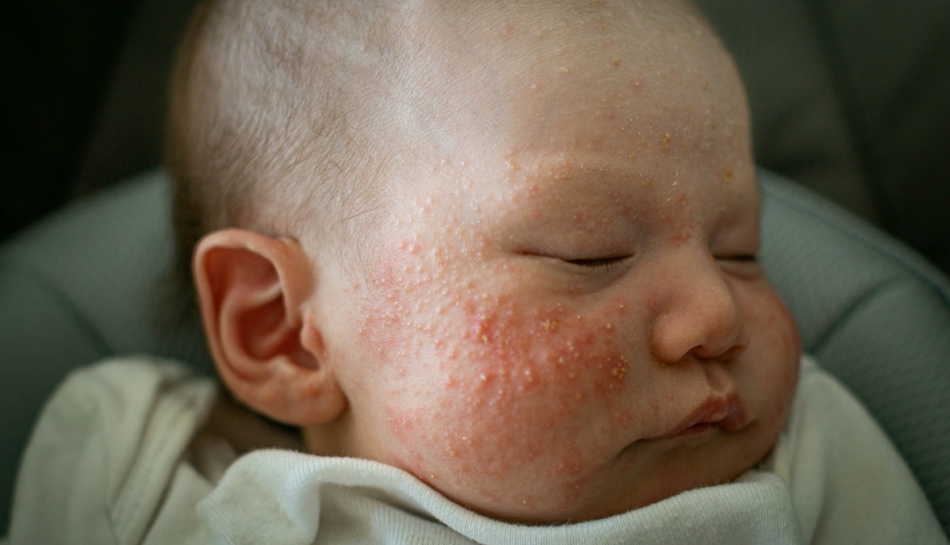 neonato affetto da acne neonatale