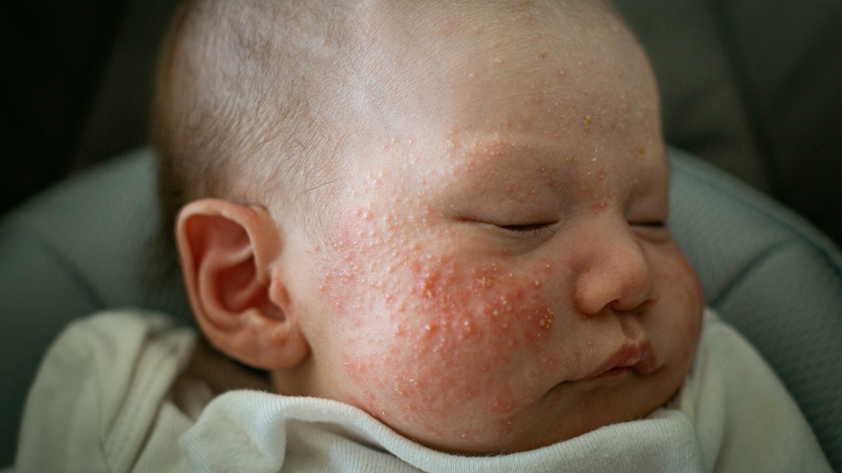 Acne neonatale: caratteristiche e durata - Uppa