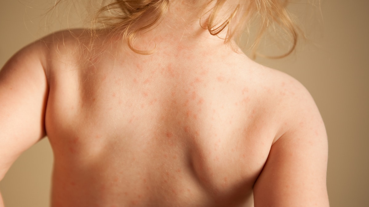pustole con liquido e prurito Dermatiti: Quali sono i tipi di dermatite, le cause e le cure main image 1