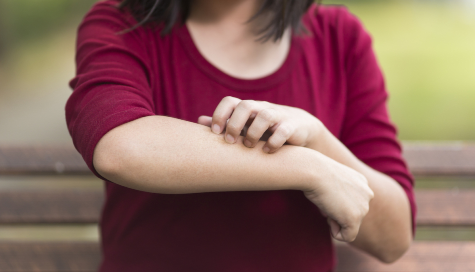 bambina con orticaria si gratta