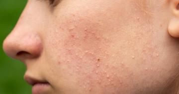 Adolescente con principio di acne