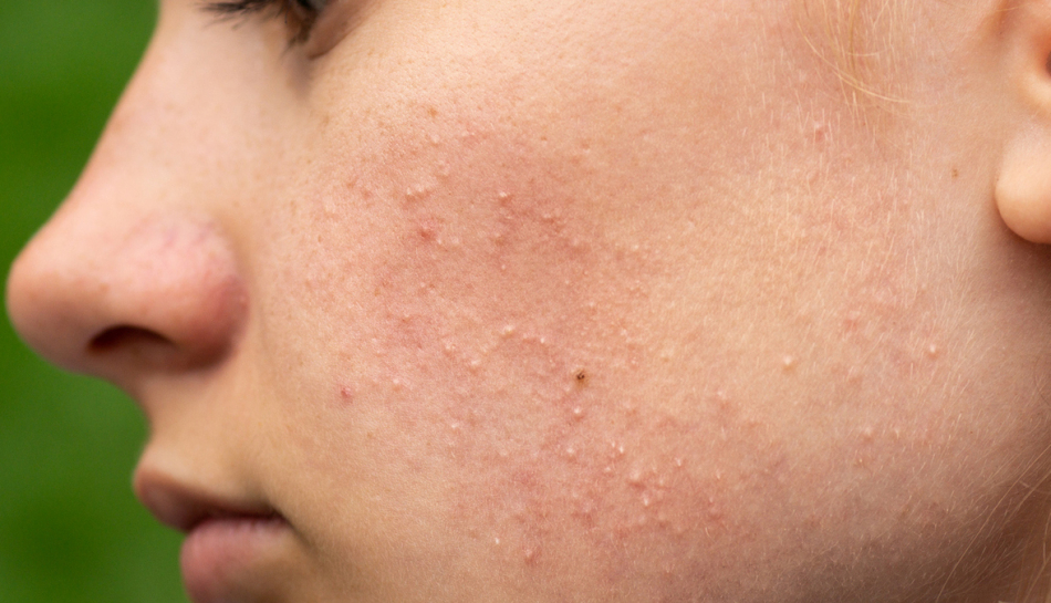 Adolescente con principio di acne