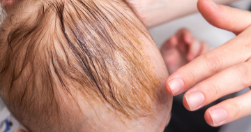 Bambino con dermatite seborroica