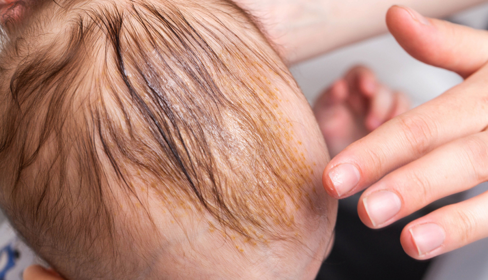 Bambino con dermatite seborroica