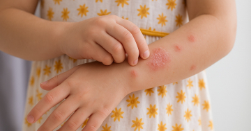 Bambina con sintomi della psoriasi sul braccio