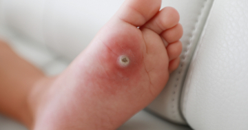Piede di un bambino con verruca