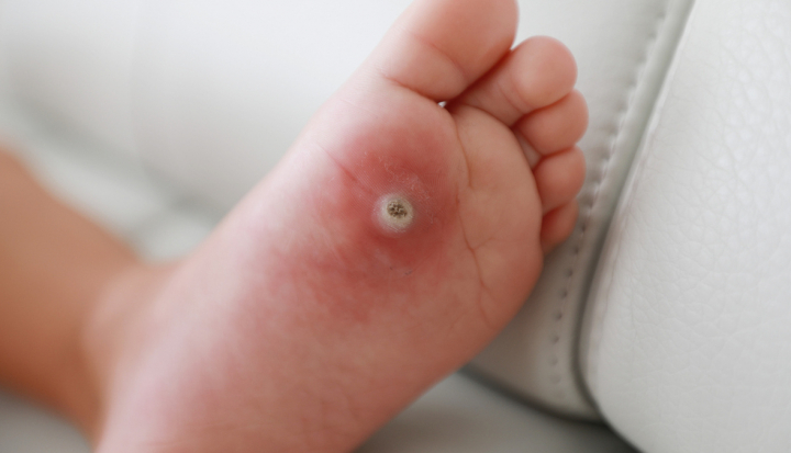 Piede di un bambino con verruca