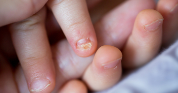 Bambino con micosi dell'unghia