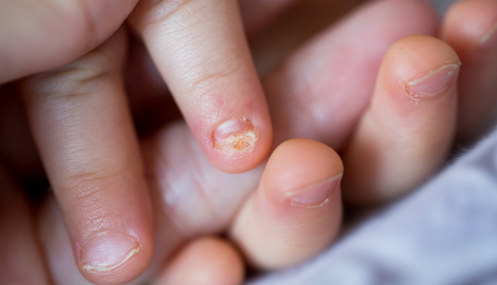 Bambino con micosi dell'unghia