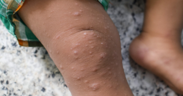 Bambino affetto da scabbia