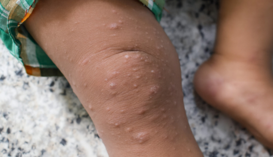 Bambino affetto da scabbia