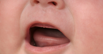 Frenulo linguale del bambino