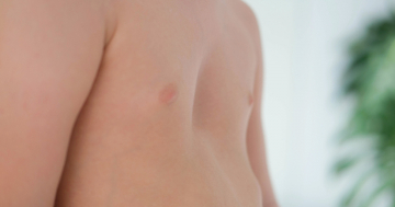 Bambino con pectus excavatum, sintomo del rachitismo