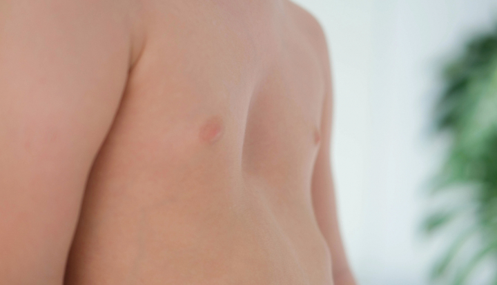 Bambino con pectus excavatum, sintomo del rachitismo