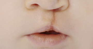 Bambino con cicatrice da intervento per palatoschiosi