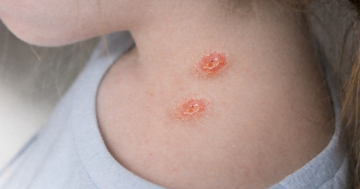 Bambina con macchie della pitiriasi rosea