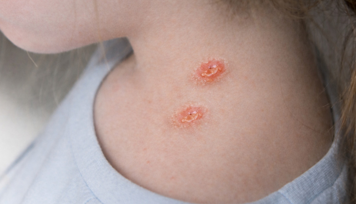 Bambina con macchie della pitiriasi rosea