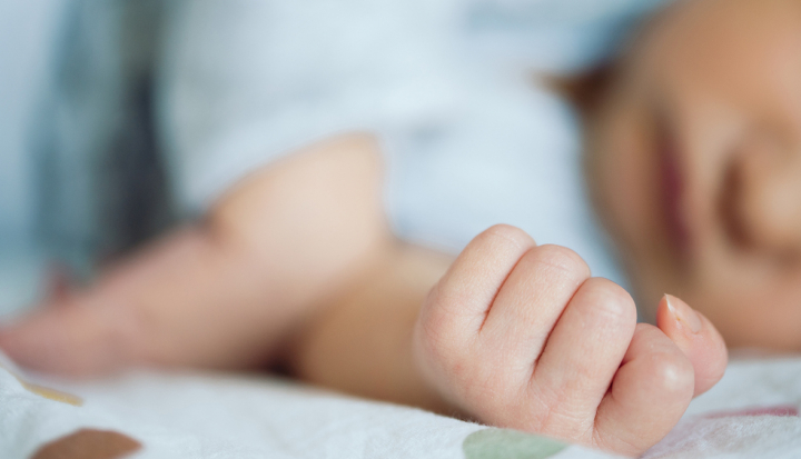 Bambino affetto da sindrome di Edwards (trisomia 18)