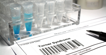 Test in laboratorio per la sindrome di Turner