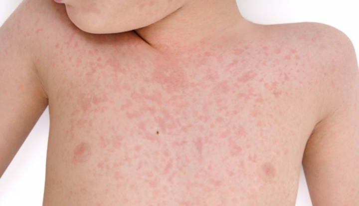 Bambino con sintomi della sindrome di Kawasaki