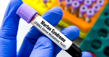 Fialetta contenente il test per la sindrome di Marfan