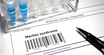Test genetico per la Sindrome di Marfan