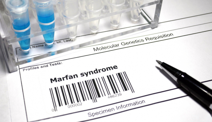 Test genetico per la Sindrome di Marfan