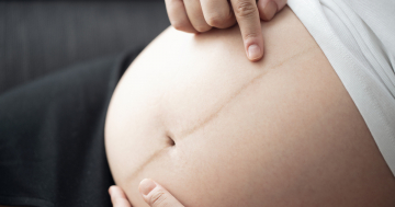 Donna in gravidanza indica la linea nigra sulla pancia