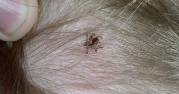 Zecca su cuoio capelluto del bambino