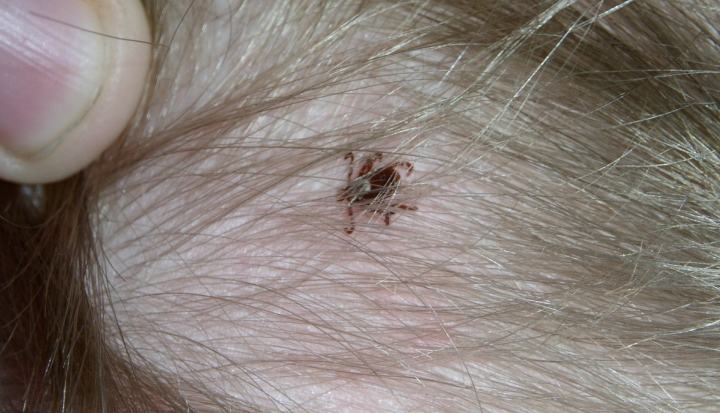 Zecca su cuoio capelluto del bambino